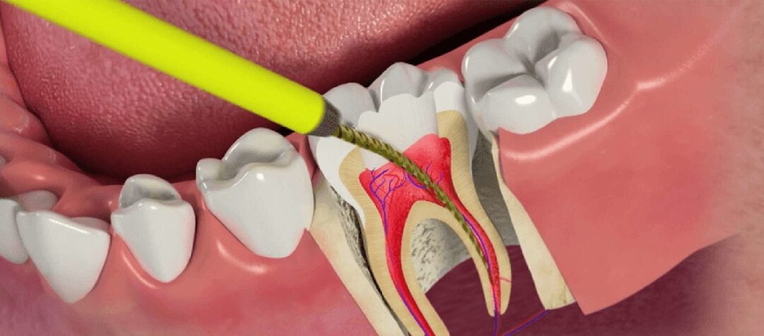 Advantages of Root Canal Treatment
